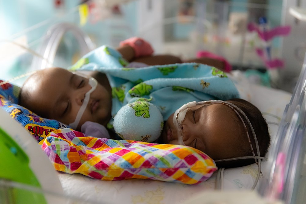 Conjoined twins are successfully separated after being locked in embrace