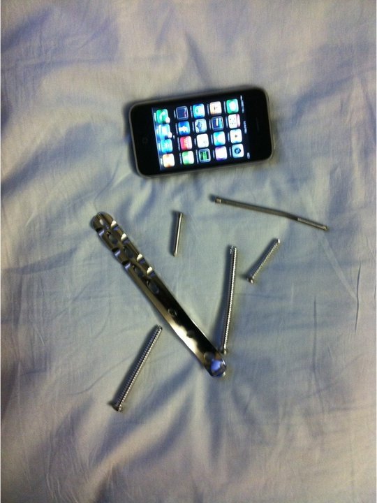 Hardware removed and replaced during surgery No. 2. Note the bent screw. No, there was no iPhone in there ... it's just for comparison.